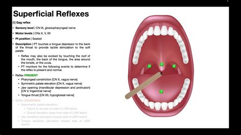 no gag reflex|No Gag Reflex: Lack of Pharyngeal Sensitivity Normal。